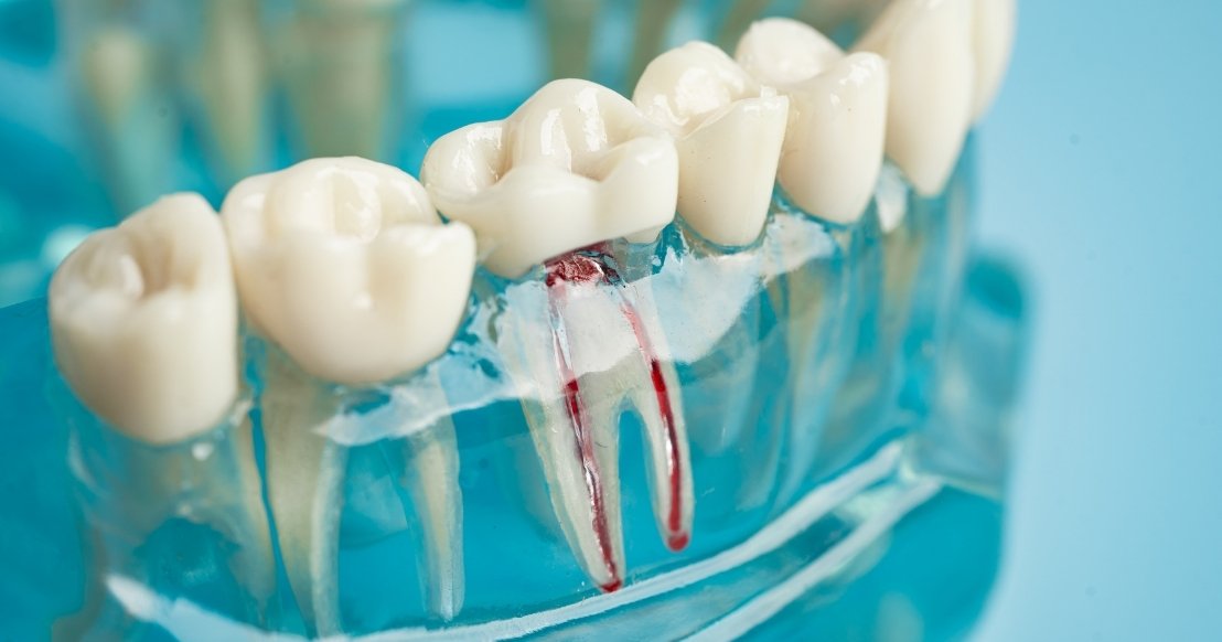 do you need painkillers after a root canal