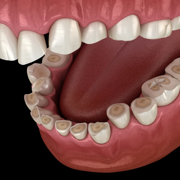 Effective Relief for Teeth Grinding