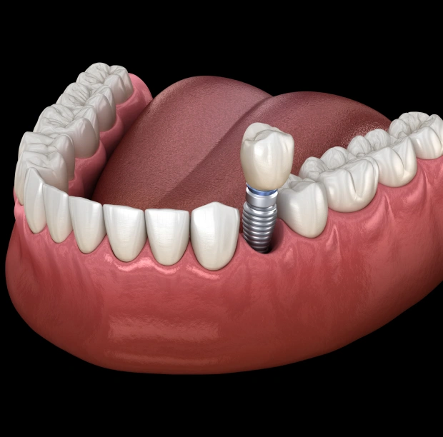 Natural-Looking Tooth Implants