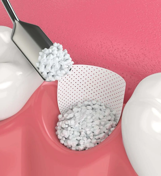 Heal Faster with PRF & Socket Preservation